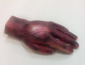 Burn Hand 2 & 3 Degree