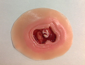 Diabetic Ulcer - 20mm
