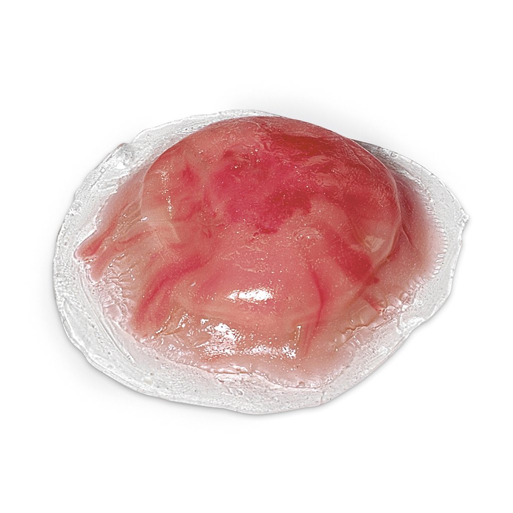 Cyst Pus Infected Replcmnt