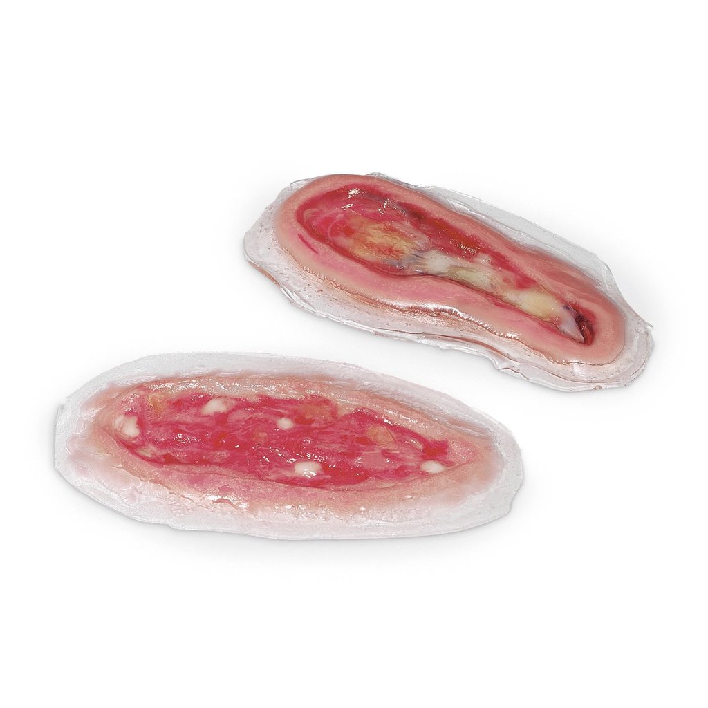 Dihiscence Wounds Repl St2