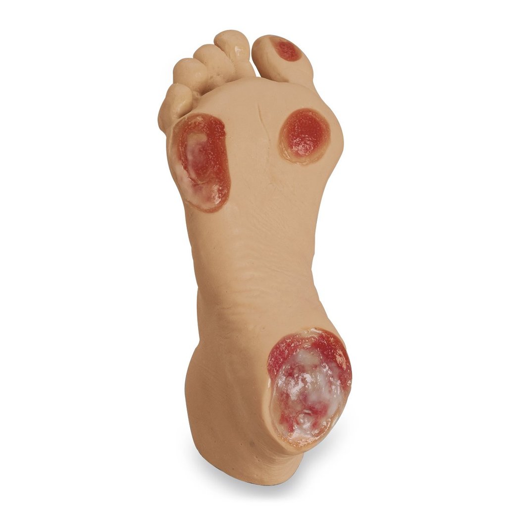 Pressure Ulcer Foot Light