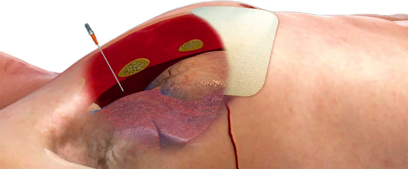 ARS For Needle Decompression (14 Gauge X 3.25 IN.)