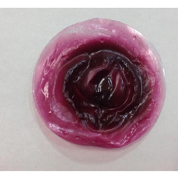 Foreign Body Protrusion Stikon