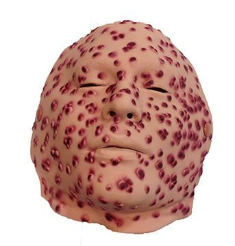 8Th-10Th Day Small Pox Moulage