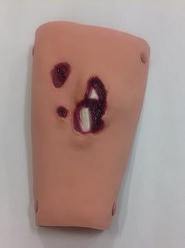 Tibia /Compound Fracture