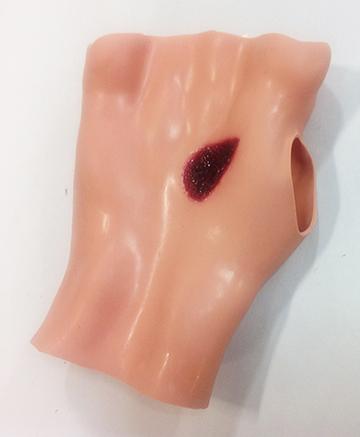Phosphorous Burn Of Hand