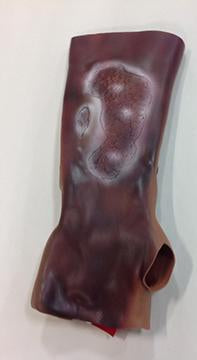 Afr/Amer Burned Forearm