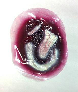Major Avulsion 8X5 Cm Stickon