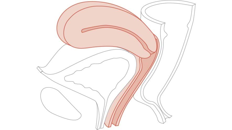 CFPT Module 1: Normal - Nulliparous Cervix