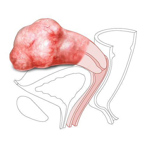 CFPT Module 2: Large Fibroid - Nulliparous Ectropion Cervix