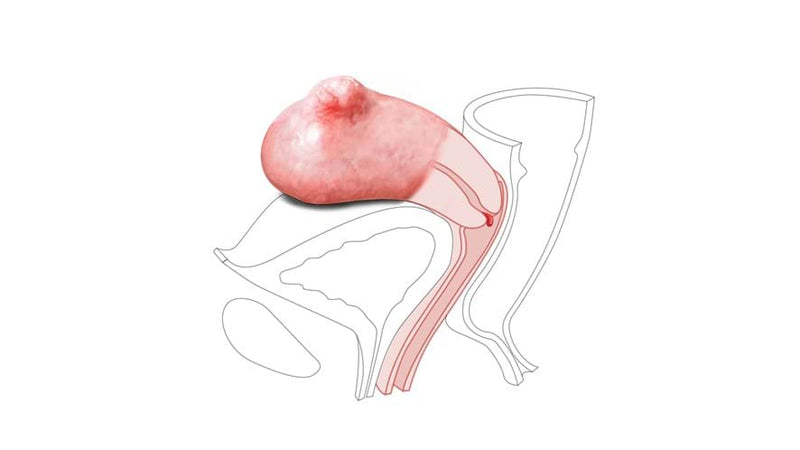 CFPT Module 3: Small Fibroid