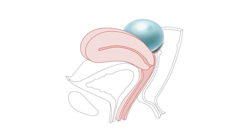CFPT Module 4: Ovarian Cyst