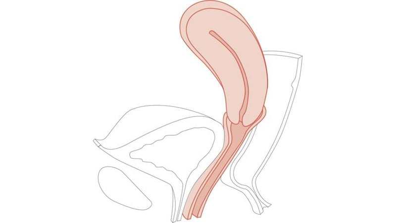 CFPT Module 5: Retroverted Uterus - Multiparous Cervix