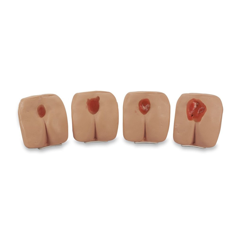 Pressure Ulcers Light St4